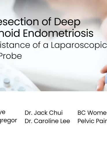 Discoid Resection of Deep Rectosigmoid Endometriosis with the Assistance of a Laparoscopic Ultrasound Probe