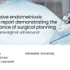 The Elusive endometriosis: A case report demonstrating the importance of surgical planning using transvaginal ultrasound
