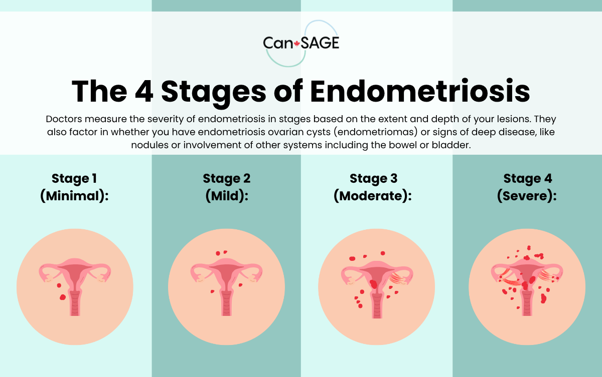 Treating Endometriosis: Medications, Surgery, Fertility, and More 11 Infographic explaining the 4 Stages of Endometriosis
