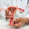 Doctor holding model of uterus to show potential effects of endometriosis on fertility